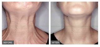 Illustration for article titled How to choose the right neck firming Cream